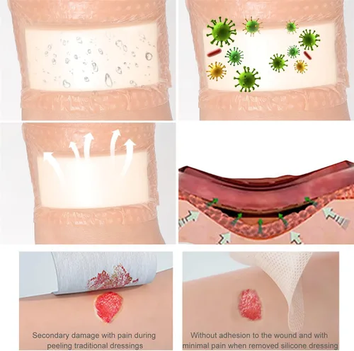 Vista 5 de Vendaje de espuma de silicona para vendaje de heridas con borde adhesivo, paquete de 5 parches súper absorbentes, almohadillas de espuma de silicona