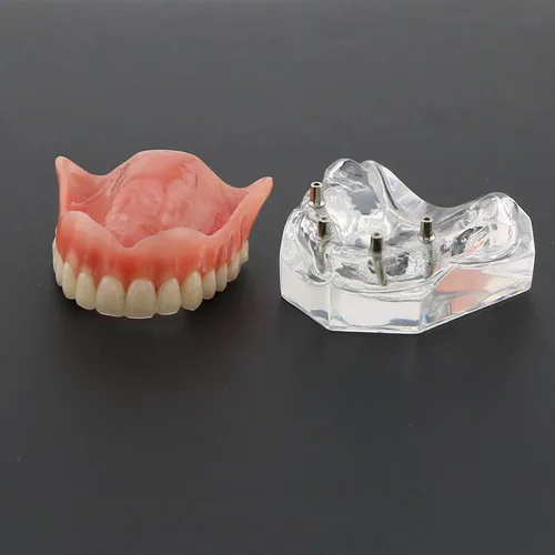 Vista 29 de Multifarious Tipos Modelo Dental Dientes Removibles Implante Ortodoncia Enseñanza Estudiar Modelos de demostración para Dentista Estudiante Escuela