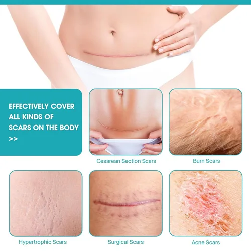 Vista 3 de Cinta de silicona para cicatrices, tiras de silicona para cicatrices de abdominoplastia, queloides, cicatrices de quemaduras, tiras de cinta