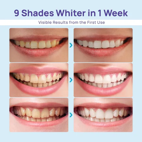 Vista 10 de Kit blanqueador de dientes Whitebite Pro para dientes sensibles – Luz LED dual + Gel de peróxido de carbamida al 35% + Gel remineralizante