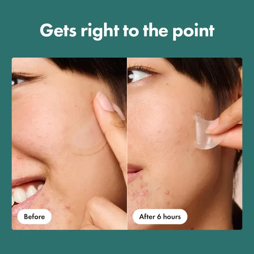 Vista 6 de Mighty Patch Micropoint Large Parches Hidrocoloides para Granos Faciales de Hero Cosmetics, Pegatinas de Acné para Granos en Etapa Temprana