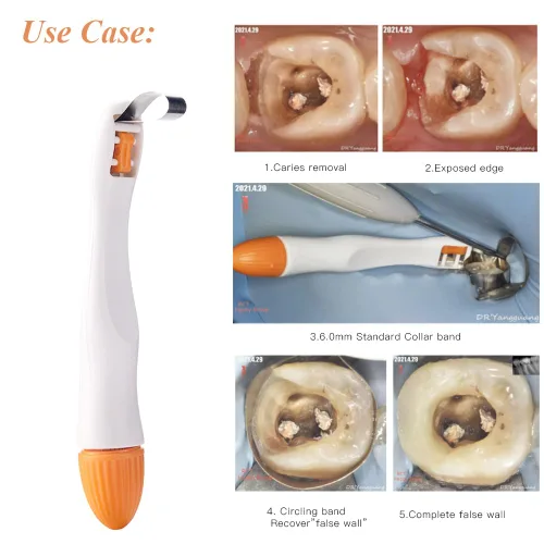 Vista 3 de Bandas de matriz dental 4.5/0.236 in Sistema de matriz proformada estándar/curvadas Matrices desechables Anillo de matriz metálica ajustable