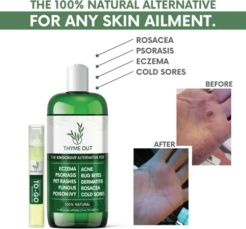 Vista 2 de Tratamiento de eccema totalmente natural, tratamiento de psoriasis, una solución todo en uno para el acné, dermatitis, rosácea, herpes labial