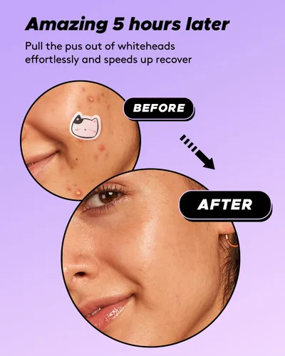 Vista 6 de LitBear Parche para acné, parche para espinillas, parche de cobertura absorbente de acné en forma de gato, parches hidrocoloides para acné