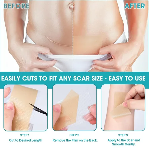Vista 7 de Cinta de silicona para cicatrices, tiras de silicona para cicatrices de abdominoplastia, queloides, cicatrices de quemaduras, tiras de cinta