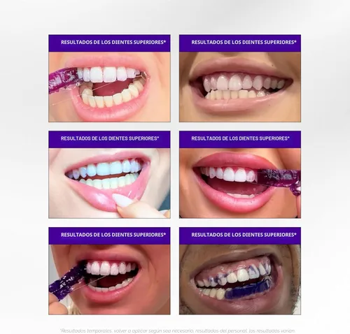 Vista 5 de Hismile Tiras blanqueadoras V34, tiras blanqueadoras de dientes, blanqueamiento dental morado, tiras blanqueadoras V34 moradas, tratamiento