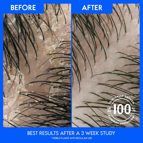 Vista 4 de Head & Shoulders Champú anticaspa, paquete doble de champú para el cuidado del cuero cabelludo seco, piritiona zinc y aceite de almendras
