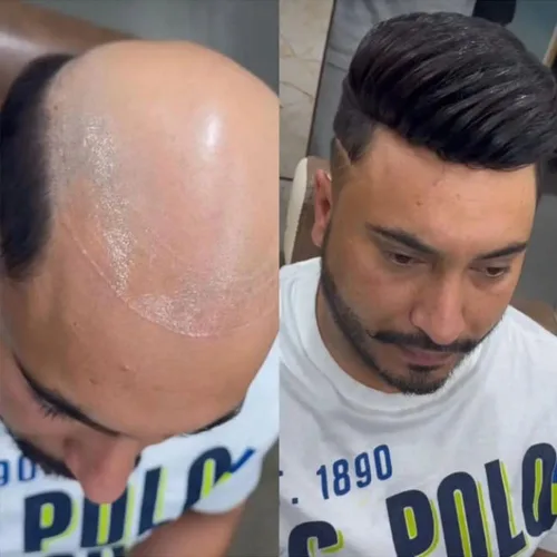 Vista 4 de Línea capilar natural tipo tupé de encaje francés con sistema de peluca de cabello humano PU para hombre, micro nudos para prótesis capilar