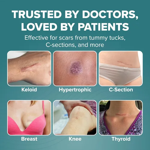 Vista 7 de Epiderm - Tiras de silicona para cicatrices, cinta de silicona de alta calidad para un cuidado óptimo de las cicatrices, versátil, flexible