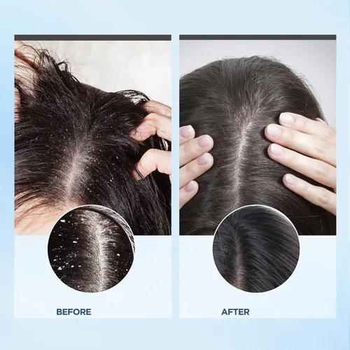 Vista 3 de Bablabear Exfoliante para el cuero cabelludo, tratamiento con picazón en el cuero cabelludo para la caspa, sin sulfato para el cabello para calmar