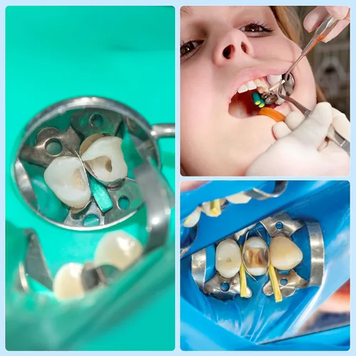 Vista 6 de JMU Cuñas Dentales de Madera, Cuñas Desechables de Madera 1.5x2x14mm, Verdes, 100 Piezas