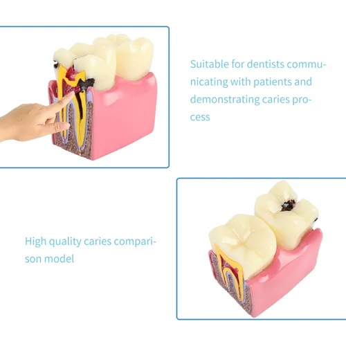 Vista 6 de Modelo de dientes de caries dentales Modelo de estudio comparativo de dientes de caries 6 veces, comparación bilateral de caries Modelo de dientes