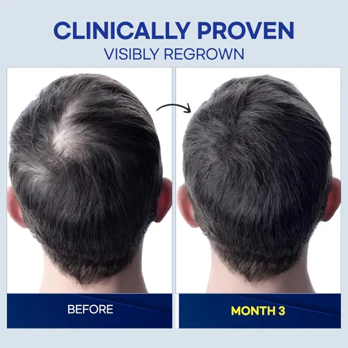Vista 4 de Minoxidil Tratamiento para el crecimiento del cabello para hombres: tratamiento de minoxidil al 5% clínicamente probado para la pérdida