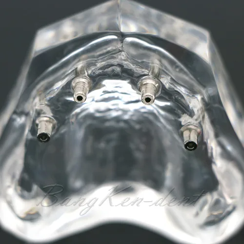 Vista 5 de Dental Implante Typodont Restauración Dientes Modelo M6001 Sobredentadura clara 4 implantes Superior Superior Demo para Estudio Enseñar