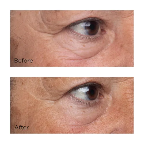 Vista 4 de Perricone MD High Potency Classics Growth Factor Firming & Lifting Eye Serum, 0.5 oz.