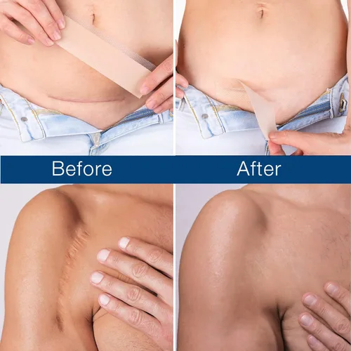 Vista 3 de Hojas de silicona para la eliminación de cicatrices quirúrgicas: cinta reutilizable para tratamiento de cicatrices queloides, cesáreas