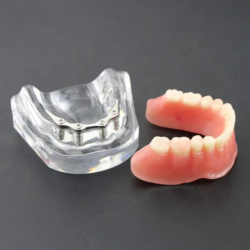 Vista 5 de Modelo de dientes de implante dental con barra de plata Typodont Sobredentadura 4 implantes inferior inferior restauración tratamiento estudio