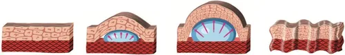 Vista 6 de NOVOGLAN® Tratamiento de fimosis no quirúrgica - Kit expansor de prepucio
