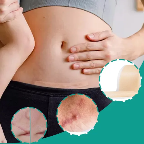Vista 6 de Cinta de silicona para cicatrices de 1.6 x 120 pulgadas, 2 rollos de cinta de silicona para cicatrices quirúrgicas, parches de queloides, hojas