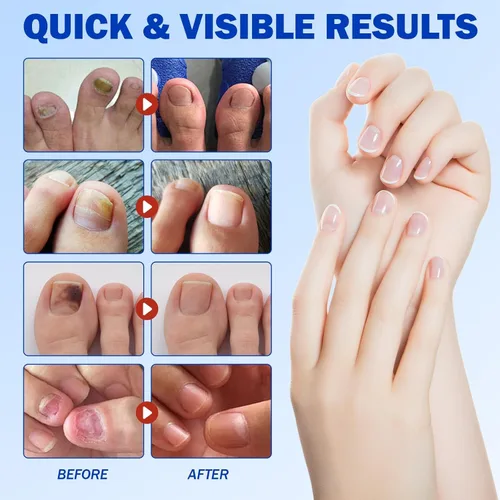 Vista 7 de Parches de uñas para reparación de uñas de los pies – 42 piezas de soporte de uñas durante la noche para uñas dañadas, gruesas o amarillas, fórmula