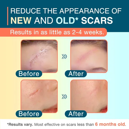 Vista 2 de Hojas de silicona para cicatrices, 1.55" x 156" - 4M, rollo de cinta de silicona médica para cicatrices, tiras de cicatrices reutilizables