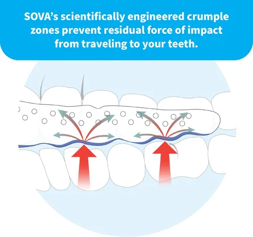 Vista 5 de Protector dental de noche Sova con estuche, para bruxismo, TMX, dolor de mandíbulas chirrido nocturno y apriete de dientes