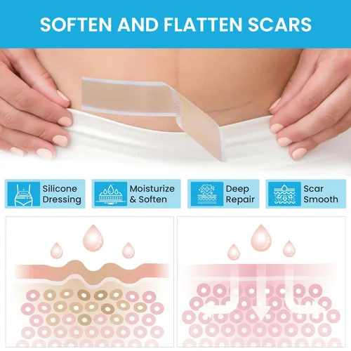 Vista 6 de Rollo de cinta de silicona suave para cicatrices, tiras de silicona reutilizables para cicatrices quirúrgicas, queloides, cicatrices de acné