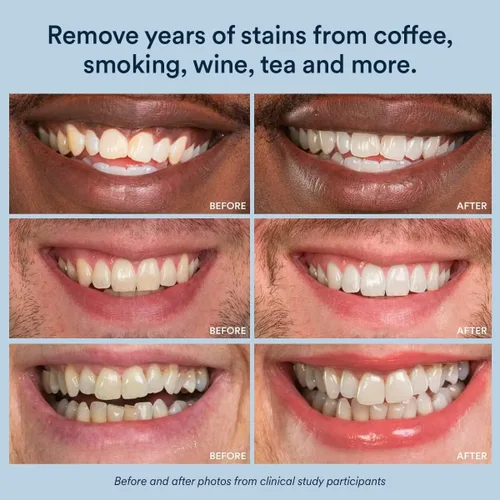 Vista 6 de Auraglow Tiras blanqueadoras de dientes, tiras blanqueadoras sensibles, 14 tratamientos de blanqueamiento, 8% de peróxido de hidrógeno