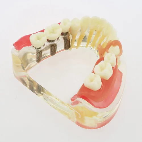 Vista 7 de Implante dental Typodont Restoration Dientes Modelo M6006 Soverdenture 3 Implantes Puente Inferior Tratamiento Demo para Estudio Enseñar