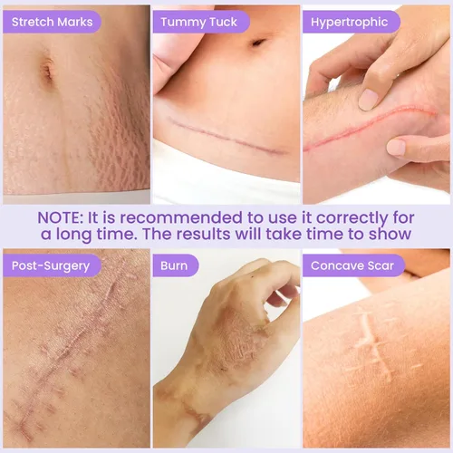Vista 3 de Hojas de silicona para cicatrices, cinta de silicona para cicatrices, cinta de cicatriz de grado médico para cicatrices quirúrgicas, eliminación