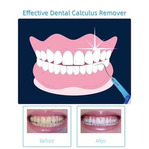 Vista 4 de Herramienta quitamanchas de dientes, kit de limpieza para el cuidado bucal con luz LED para dentista, limpieza bucal familiar, raspador dental