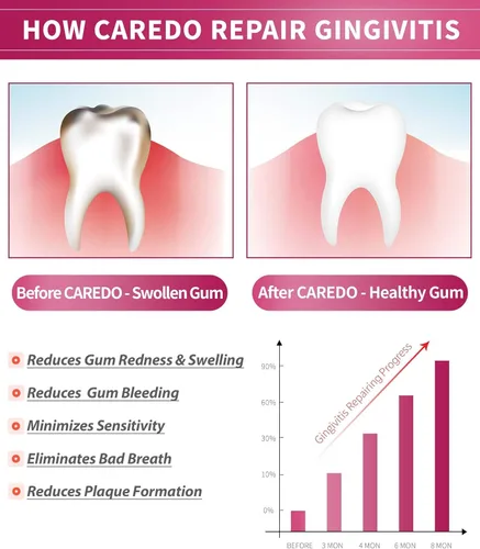 Vista 2 de CAREDO Pasta de dientes para gingivitis, reparación de encías sangrantes, tratamiento de encías inflamadas para sensibilidad de las encías