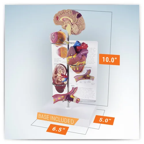 Vista 5 de GPI Anatomicals - Set de modelo de hipertensión, réplica para educación de anatomía y fisiología humana, modelo anatómico para consultorios médicos