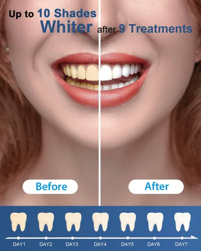 Vista 6 de MySmile Paquete de repuesto de bolígrafo de gel blanqueador de dientes, 3 bolígrafos blanqueadores de dientes no sensibles, blanqueador de dientes