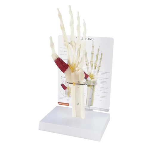 GPI Anatomicals - Modelo de mano y muñeca, réplica de mano y muñeca con síndrome del túnel carpiano para la educación en anatomía y fisiología