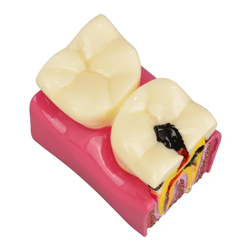 Vista 8 de Ultrassist Modelo de caries dental, modelo de demostración de caries dental, modelo de enseñanza de anatomía dental para educación dental