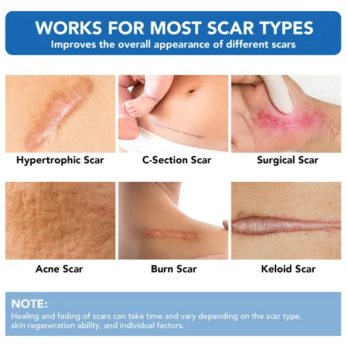 Vista 2 de Hojas de silicona para cicatrices, cinta adhesiva de silicona (rollo de 1.6 x 60 pulgadas - 4.9 ft), cinta adhesiva reutilizable, suave y de grado