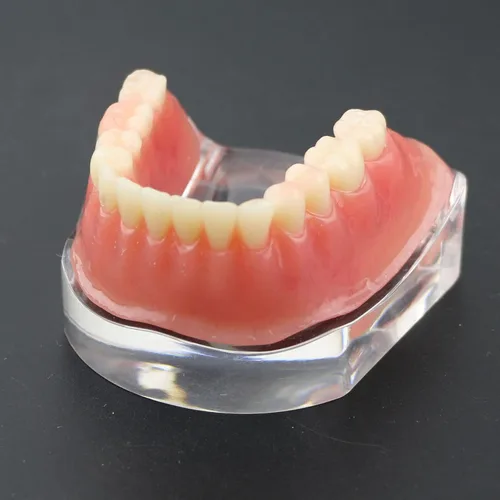 Vista 2 de Modelo de dientes de implante dental con barra de plata Typodont Sobredentadura 4 implantes inferior inferior restauración tratamiento estudio
